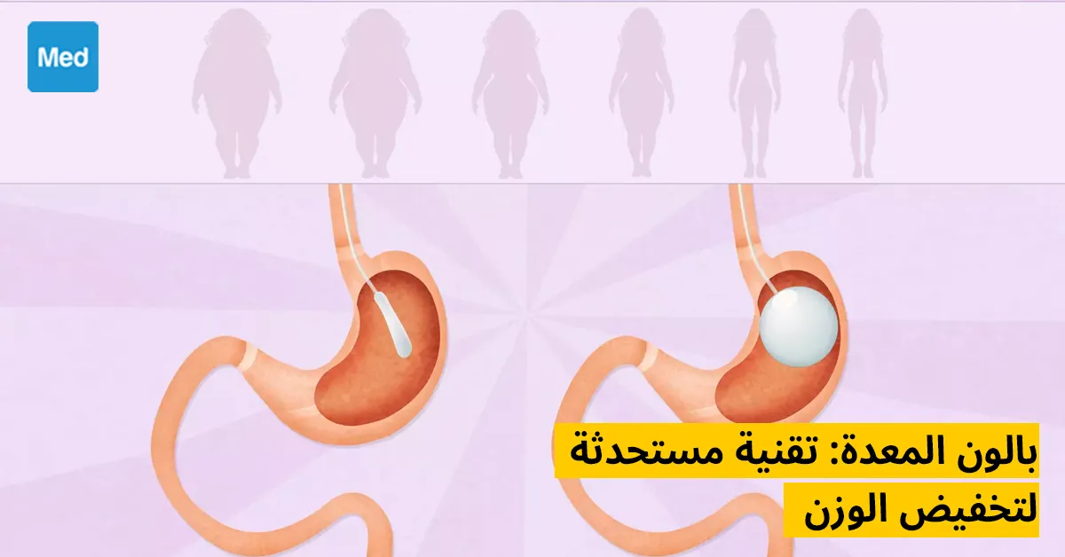 بالون المعدة: تقنية مستحدثة لتخفيض الوزن